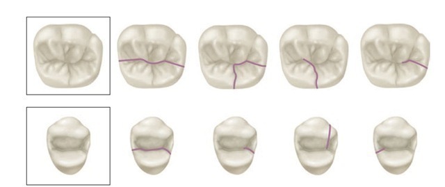 Fracture lines most commonly seen in first maxillary premolar and first mandibular molar. 