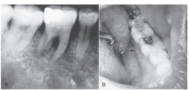  A, Radiograph showing periapical radiolucency associated with parulis shown in B. B, Fracture of distolingual cusp related to undermined tooth structure and amalgam restoration. 