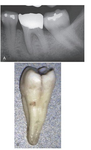 A, Radiograph showing loss of lamina dura on the mesial root of the mandibular molar but no indication of root fracture. B, Longitudinal fracture on the distal aspect of the crown and coronal root. 