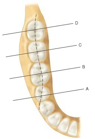 Diagrammatic representation of sections through the mandible at the position of the second premolar and first, second, and third molars. Dotted line represents the faciolingual position of the mandibular canal. 