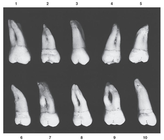 Maxillary third molar, buccal aspect. Ten typical specimens are shown. 