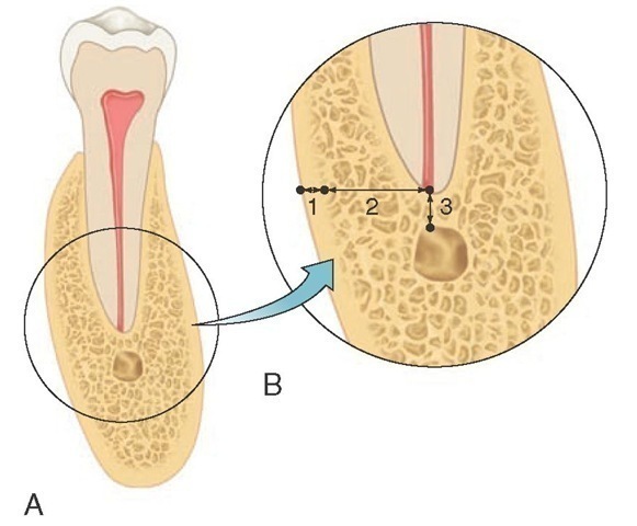 A, Diagrammatic representation of a cross section of the mandible. B, Enlarged view with three measurements taken as indicated in the text. 