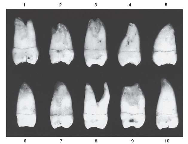 Maxillary third molar, mesial aspect. Ten typical specimens are shown. 