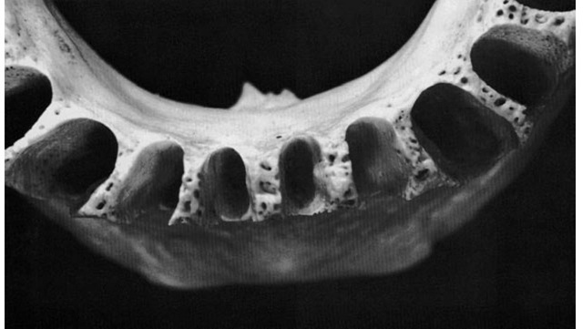 Closeup view of one of the three separate divisions of the mandibular alveoli (as shown in Figures 14-19, 14-20, and 14-21). This picture indicates the relative sizes and shapes of the incisors for comparison with other mandibular teeth. 