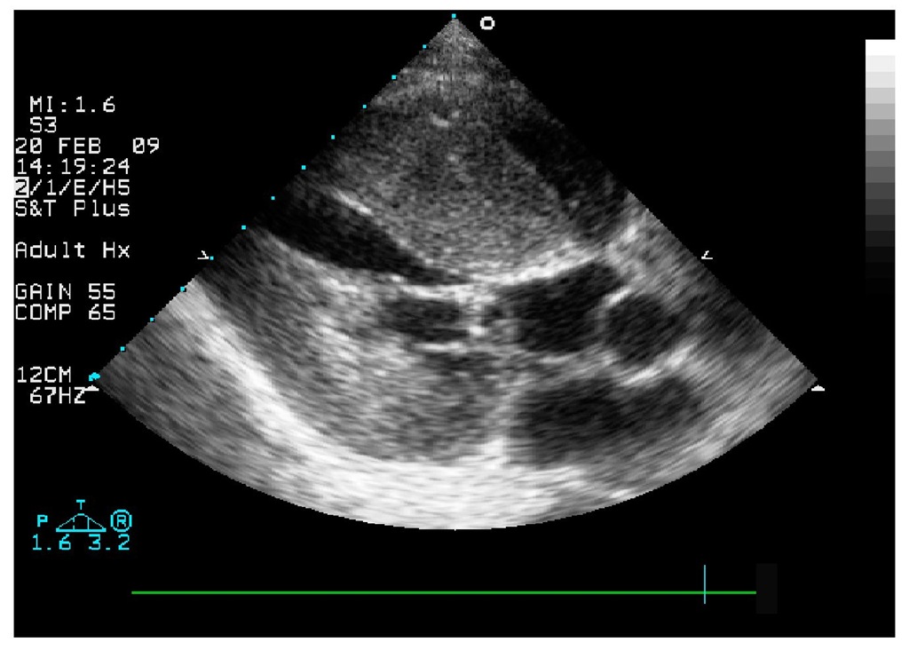 Transthoracic echocardiography, parasternal long axis view with impressive finding of subaortic obstruction. 