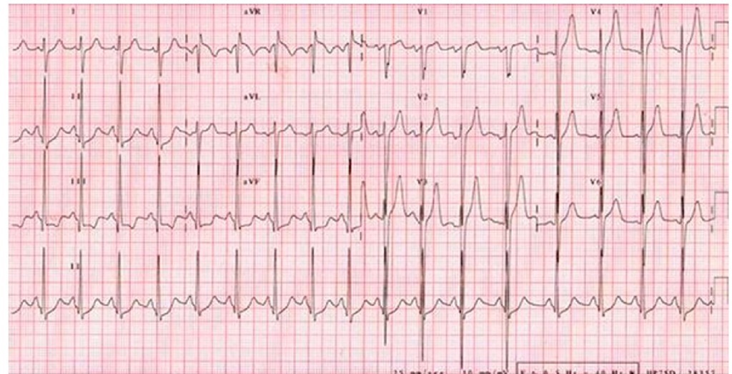 Electrocardiogram of a 14 year-old male patient with a vertical QRS axis (+120°) and voltage criteria for left ventricular hypertrophy. A limb lead voltage sum > 10 mV is considered a risk factor for sudden death in children.