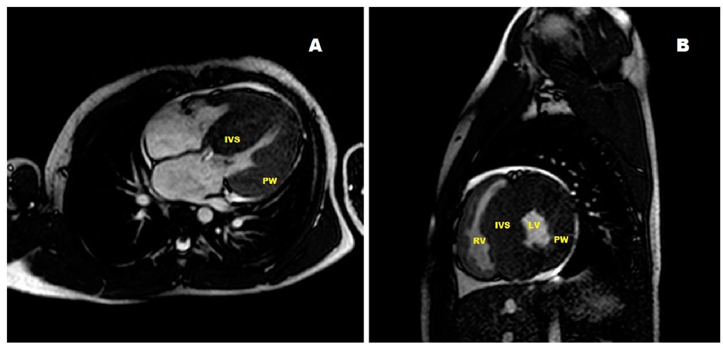 Long axis view of a cardiac magnetic resonance image of a 5 year-old asymptomatic boy with severe hypertrophic cardiomyopathy. B: Magnetic resonance imaging of a short axis projection of the heart of a 3 year-old boy with severe heart failure. (IVS: interventricular septum, LV: left ventricle, PW: posterior wall, RV: right ventricle).