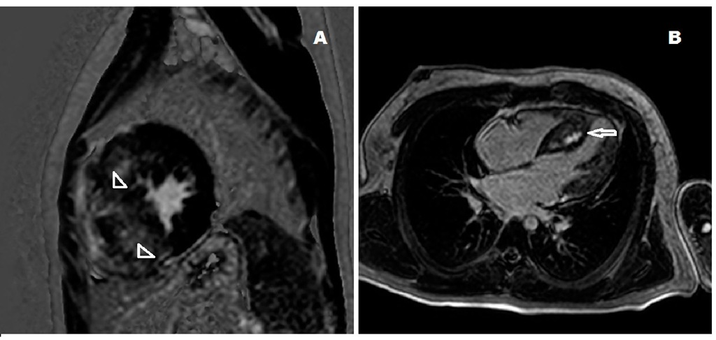 Cardiac magnetic resonance image of the heart of a patient with positive delayed gadolinium enhancement indicating a diffuse pattern of fibrosis (arrowheads). B: Long axis view of a cardiac magnetic resonance image of the heart of a 9 year-old boy with a localized delayed gadolinium enhancement image in the interventricular septum (arrow).