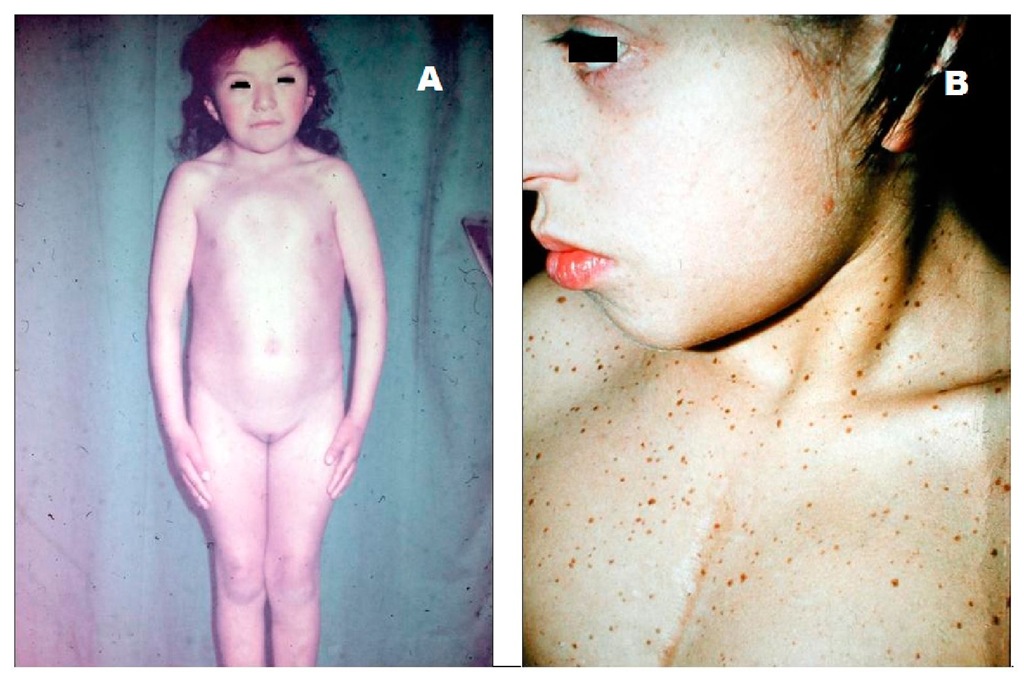  A. Phenotype of a 10-year-old girl with Noonan's syndrome and hypertrophic cardiomyopathy. There is short stature, peculiar face, eyelid ptosis with downward slant, ocular and mammillar hypertelorism, low set ears, pterigium colli, and a prominent chest. B. Ten-year-old girl with LEOPARD syndrome. The multiple lentigines and hypertrophic obstructive cardiomyopathy became apparent long after she had been operated on for severe pulmonary valve stenosis when she was 6-month old.