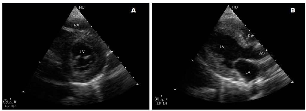 Short and long axis parasternal echocardiographic views of the heart of a 19-year-old female with type III glycogen storage disease with concentric hypertrophic cardiomyopathy. 