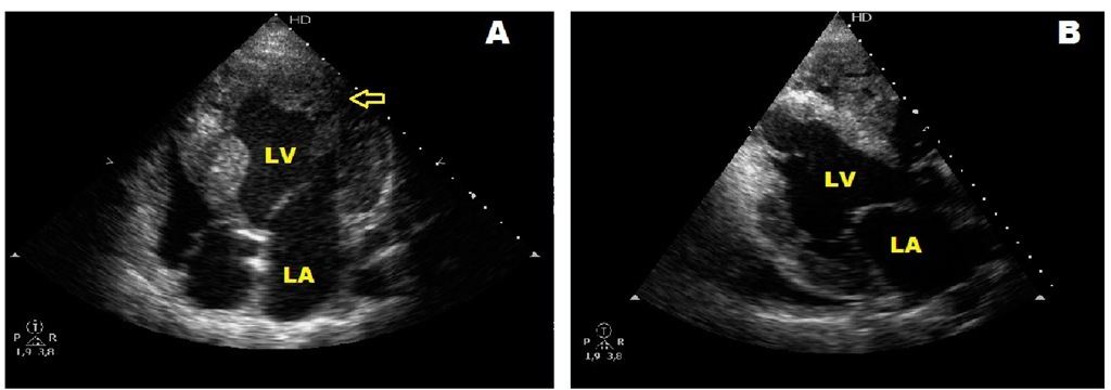  A and B. Echocardiographic four-chamber view of two sisters followed since infancy showing hypertrophic cardiomyopathy and associated left ventricular noncompaction. The arrow in A points deep sinusoid tracts. LV: left ventricle, LA: left atrium. 