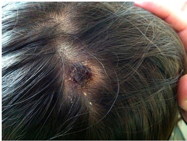 DEBONEL/TIBOLA patient with the typical crusted lesion on the scalp. 