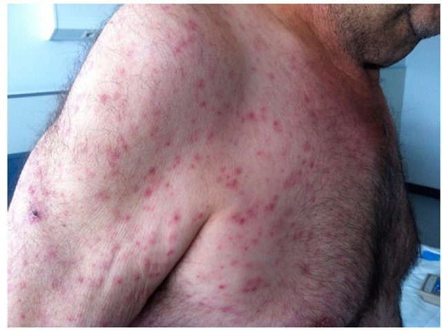Eschar (tache noire) and maculo-papular rash in a patient with Mediterranean spotted fever. 