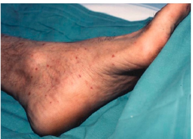 Vasculitic rash affecting soles in a patient with Mediterranean spotted fever. 