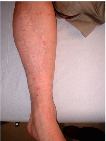 Vesicular rash in a patient with African-tick bite fever. 