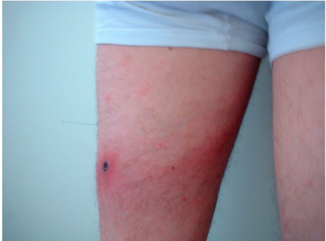 Eschar and lymphangitis in a patient with African tick-bite fever. 