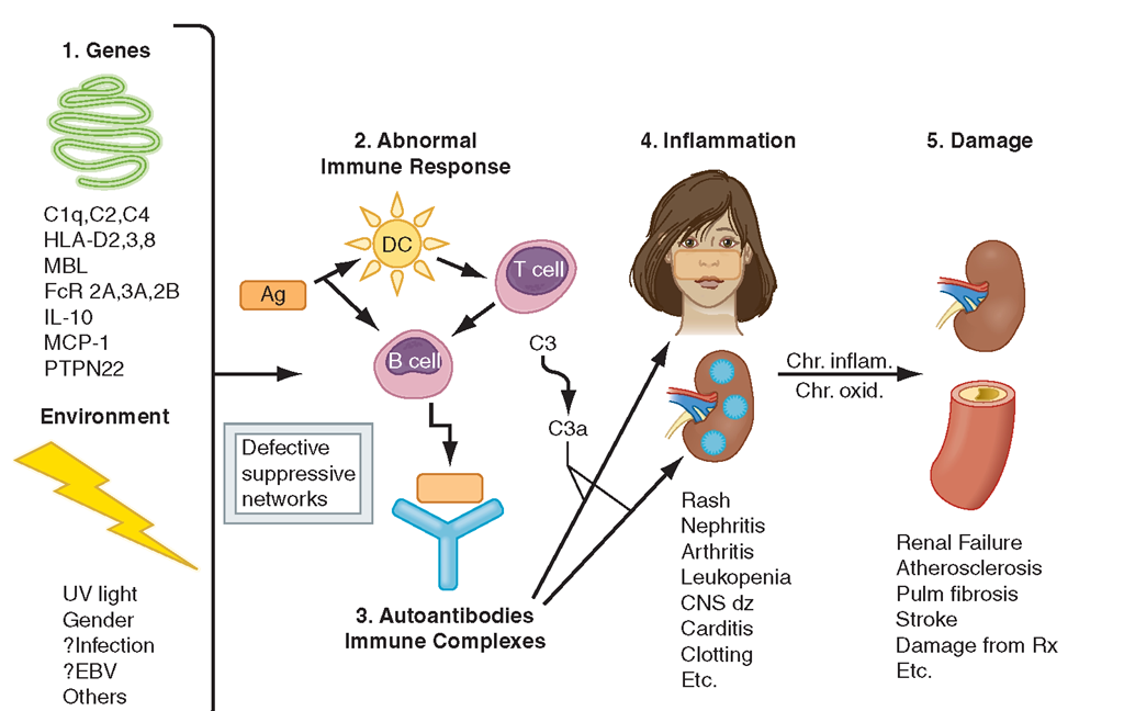 Pathogenesis of SLE. Genes confirmed in more than one independent cohort as increasing susceptibility to SLE or lupus nephritis are listed. Gene-environment interactions result in abnormal immune responses that generate pathogenic autoantibodies and immune complexes that deposit in tissue, activate complement, cause inflammation, and over time lead to irreversible organ damage. Ag, antigen; C1q, complement system; C3, complement component; CNS, central nervous system; DC, dendritic cell; EBV, Epstein-Barr virus; HLA, human leukocyte antigen; FcR, immunoglobulin Fc-binding receptor; IL, interleukin; MBL, mannose-binding ligand; MCP, monocyte chemotactic protein; PTPN, phos-photyrosine phosphatase; UV, ultraviolet. 