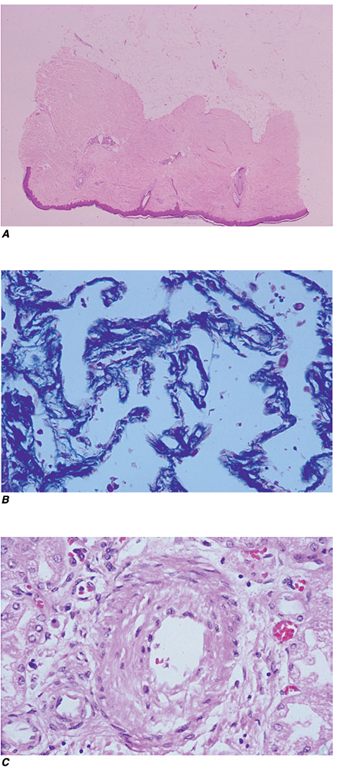 Pathologic findings in systemic sclerosis. A. Dermal sclerosis. The skin is thickened due to marked expansion of the dermis. Thick bundles of densely packed collagen replaces skin appendages. B. Early interstitial lung disease. Diffuse fibrosis of the alveolar septae and a chronic inflammatory cell infiltrate. Trichrome stain. C. Pulmonary arterial obliterative vasculopathy. Striking intimal hyperplasia and narrowing of the lumen of a small pulmonary artery, with minimal interstitial fibrosis, in a patient with limited cutaneous SSc. 