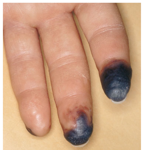 Digital necrosis. Sharply demarcated necrosis of the fingertip in a patient with limited cutaneous SSc. 