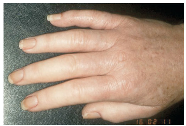 Sclerodactyly. Note skin induration and fixed flexion contractures at the proximal interphalangeal joints in a patient with limited cutaneous SSc. 