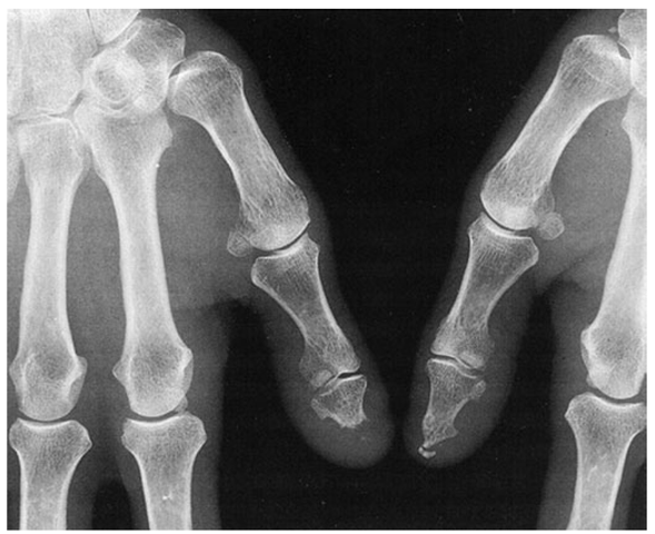 Acro-osteolysis. Note dissolution of terminal phalanges in a patient with long-standing limited cutaneous SSc. 