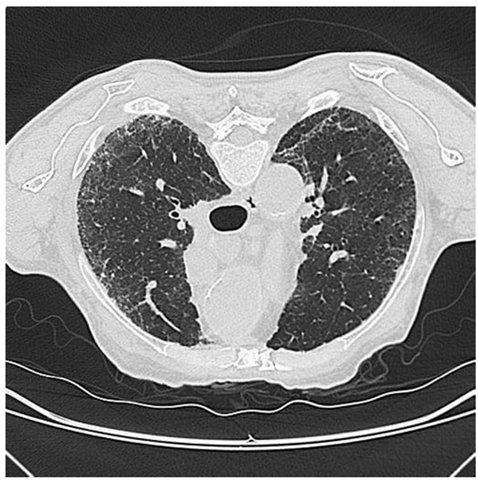 High-resolution CT scan of the lungs. Note peripheral bilateral reticulonodular opacifications in the lower lobes of the lungs in a patient with diffuse cutaneous SSc. 