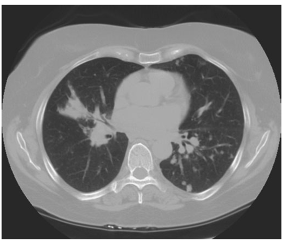 High-resolution CT scan of chest demonstrating patchy reticular nodularity, including areas of confluence. 