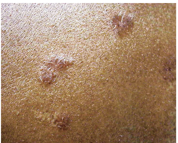Maculopapular lesions on the trunk of a sarcoidosis patient. 