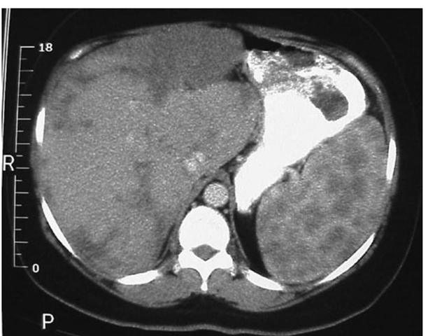 CT scan of the abdomen after oral and intravenous contrast. The stomach is compressed by the enlarged spleen. Within the spleen, areas of hypo- and hyperdensity are identified. 