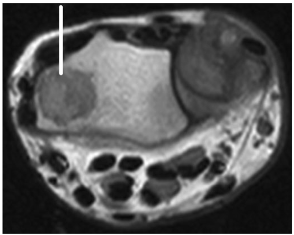 MRI of wrist demonstrating large cyst in a sarcoidosis patient (line). 