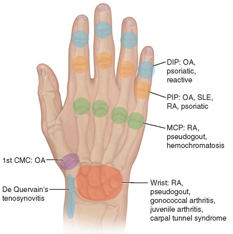 Sites of hand or wrist involvement and their potential disease associations. (DIP, distal interphalangeal; OA, osteoarthritis; PIP, proximal interphalangeal; SLE, systemic lupus erythematosus; RA, rheumatoid arthritis; MCP, metacarpophalangeal; CMC, carpometacarpal.) 
