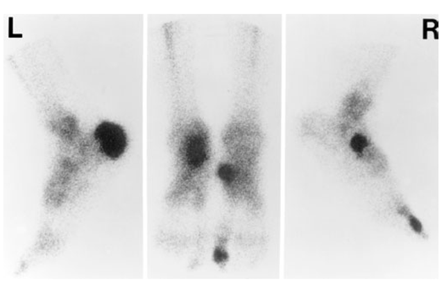 [99mTc]diphosphonate scintigraphy of the feet of a 33-year-old black male with reactive arthritis, manifested by sacroili-itis, urethritis, uveitis, asymmetric oligoarthritis, and enthesitis. This bone scan demonstrates increased uptake indicative of enthesitis involving the insertions of the left Achilles tendon, plantar aponeurosis, and right tibialis posterior tendon as well as arthritis of the right first interphalangeal joint. 