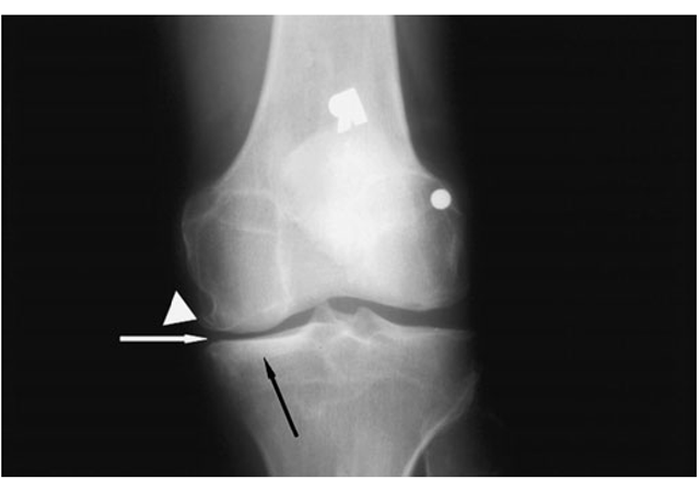 X-ray of knee with medial osteoarthritis. Note the narrowed joint space on medial side of the joint only (white arrow), the sclerosis of the bone in the medial compartment providing evidence of cortical thickening (black arrow), and the osteophytes in the medial femur (white wedge). 