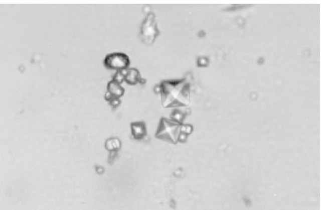Bipyramidal and small polymorphic calcium oxalate crystals from synovial fluid are classical finding in CaOx arthropathy (ordinary light microscopy; 400x). 
