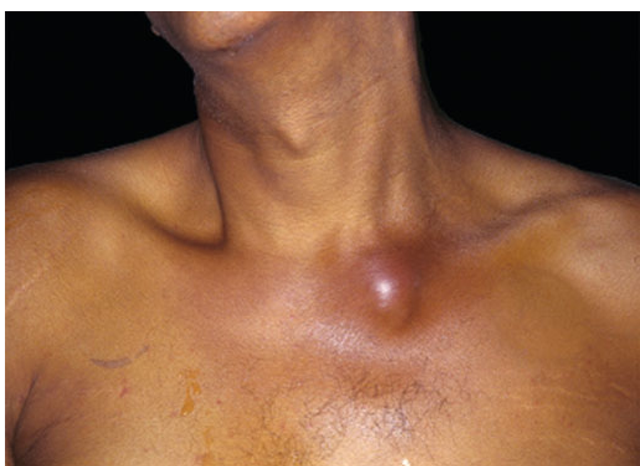 Acute septic arthritis of the sternoclavicular joint. A man in his 40s with a history of cirrhosis presented with a new onset of fever and lower neck pain. He had no history of IV drug use or previous catheter placement. Jaundice and a painful swollen area over his left sternoclavicular joint were evident on physical exam. Cultures of blood drawn at admission grew group B Streptococcus. The patient recovered after treatment with IV penicillin. 