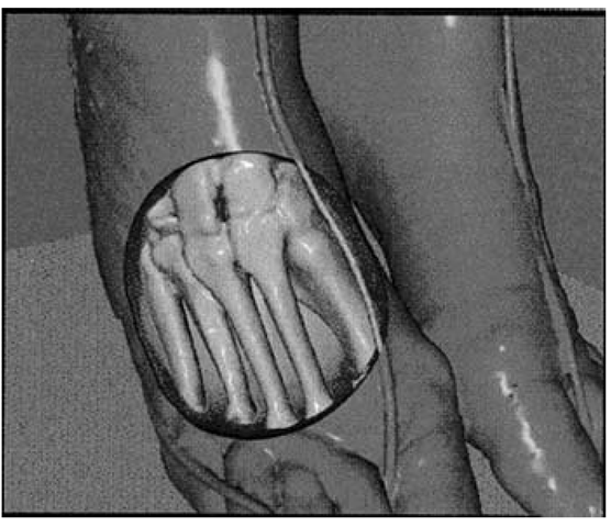 Foot with bones exposed ([ScML98]). 