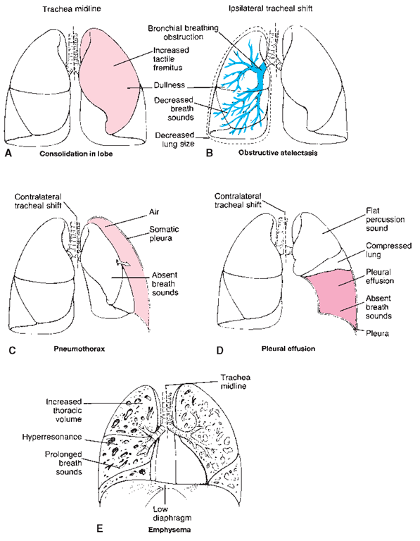 Respiratory system disorders and their comparative effects on the lungs. (A) Consolidation within a lobe: trachea in center, dull sound in affected lobe. (B) Obstructive atelectasis: trachea shifts to affected (ipsilateral) side; decreased lung size, decreased breath sounds. (C) Pneumothorax: trachea shifts to other (contralateral) side; breath sounds absent on affected side. (D) Pleural effusion or hemothorax (fluid or blood pooling in pleural cavity): trachea shifts to other side; absent breath sounds in affected lobe; lung compressed.(E) Emphysema: enlarged (barrel) chest, prolonged breath sounds, hyperresonance (echo), trachea in center.
