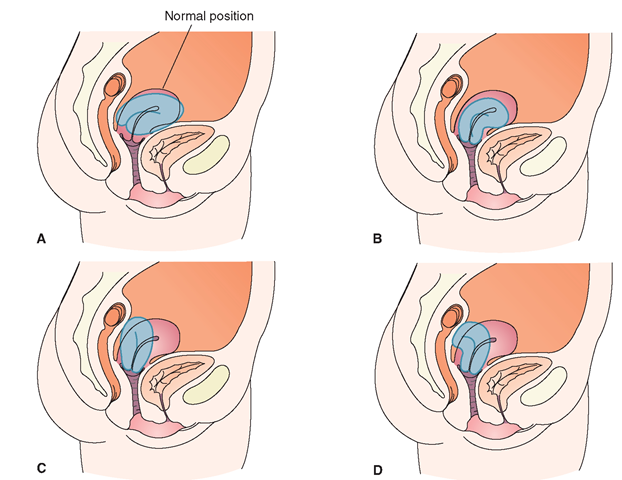  Variations in uterine position. (A) Anteversion. (B) Anteflexion. (C) Retroversion. (D) Retroflexion.