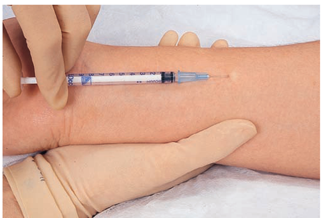 Skin testing by intradermal injection. With the needle held nearly flat against the skin and the bevel up, the needle is inserted approximately one-eighth of an inch under the epidermis. The test agent is injected slowly as a small blister appears. Signs of positive reaction to the agent will appear in 24 to 48 hours.