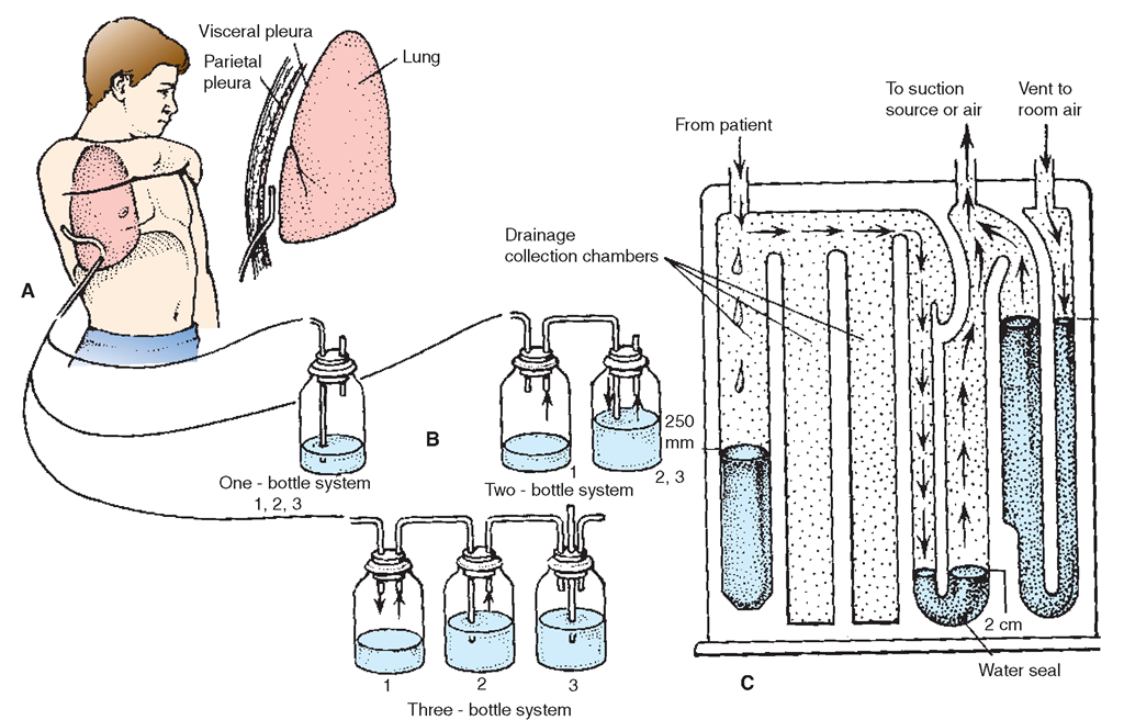 Chest drainage systems. (A) Strategic placement of a chest catheter in the pleural space. (B) Three types of mechanical drainage systems. (C) A Pleur-Evac operating system: (1) the collection chamber, (2) the water-seal chamber; and (3) the suction control chamber The Pleur-Evac is a single unit with all three bottles identified as chambers.