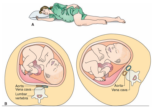 (A) Rest position during pregnancy. The knees and elbows should be slightly bent, the muscles limp, and the breathing slow and regular Notice that the weight of the fetus is resting on the bed. (B) Supine hypotension syndrome can occur if a pregnant woman lies on her back, trapping blood in her lower extremities. If a woman turns on her side, pressure is lifted off of the vena cava.