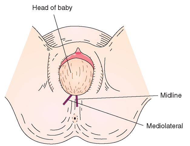 Position of episiotomy incision in a woman during Stage II. The baby’s head is presenting to the vaginal outlet (crowning).