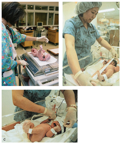 (A) Weighing a newborn. Notice the protective hand held over the infant. (B)Length should be measured soon after birth, to serve as a baseline from which to judge future growth. (C) The circumference of the head is measured by placing a non-stretchable tape measure just above the eyebrows and over the most prominent part of the occiput.