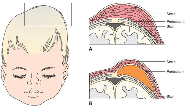 (A) Caput succeda-neum: From the pressure of the birth canal, an edematous area is present beneath the scalp. Note how it crosses the midline of the skull. (B) Cephalhematoma: A small capillary beneath the periosteum of the skull bone has ruptured, and blood has collected under the periosteum of the bone. Note how the swelling now stops at the midline. Because the blood is contained under the periosteum, it is necessarily stopped by a suture line.