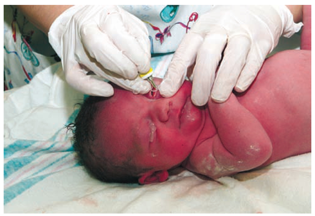 Herpes, Neonatal - WebMD