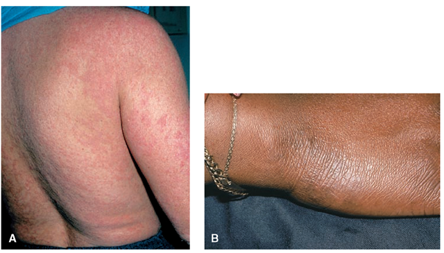 Examples of atopic dermatitis (eczema). 