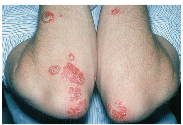 Characteristic primary lesions of psoriasis. 