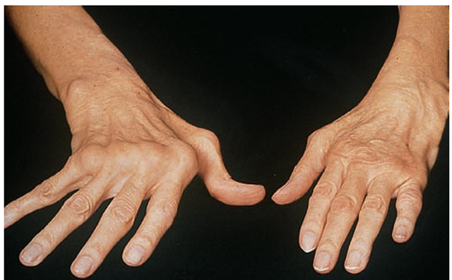 A severe dislocation called subluxation of the fingers in rheumatoid arthritis. 