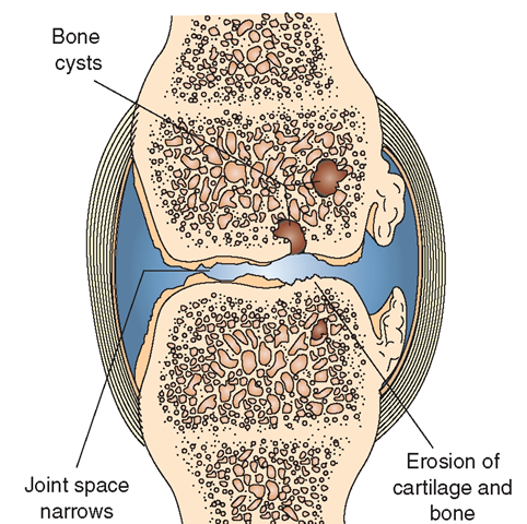 Joint changes in osteoarthritis. Notice that the left side shows early changes, with joint space narrowing and cartilage breakdown. The right side shows severe progression, with lost cartilage. 