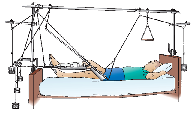 The client in a balanced suspension traction with a Thomas leg splint. The client uses the trapeze to help move vertically. It is important that the line of pull on the traction is maintained. Note that the weights hang freely at the head and foot of the bed. 